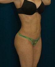 Brazilian Butt Lift on thin female