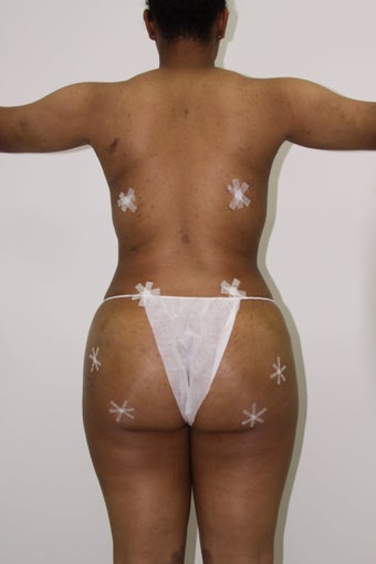 Brazilian Butt Lift