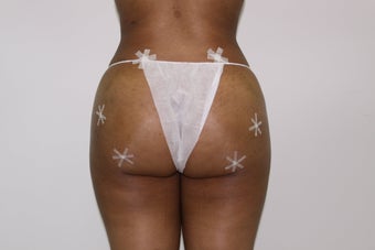 Brazilian Butt Lift