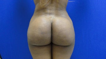 Brazilian Butt Lift/Fat Grafting Buttock Augmentation