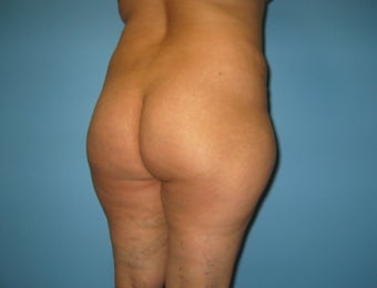 Buttock augmentation (Brazilian buttock lift)