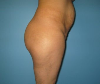 buttock augmentation (Brazilian buttock lift)