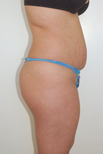Brazilian Buttock lift