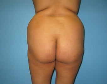 buttock augmentation (Brazilian buttock lift)