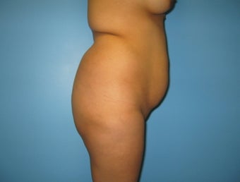 buttock augmentation (Brazilian buttock lift)