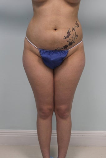 Brazilian butt lift
