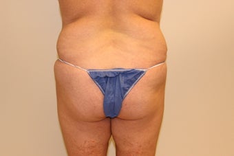 Brazilian butt lift