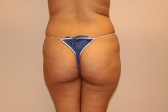 Brazilian butt lift