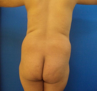 Brazilian Butt Lift