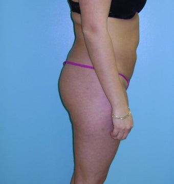 Brazilian Butt Lift- Buttocks Augmentation