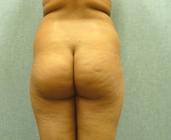 Brazilian Butt Lift