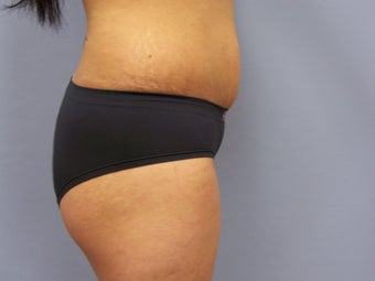 Brazilian Butt-lift