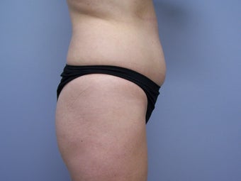 Brazilian Butt-lift