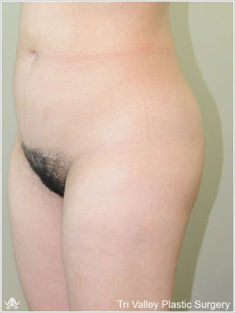  Brazilian Buttock Lift