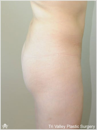  Brazilian Buttock Lift