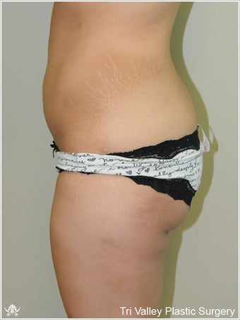  Brazilian Buttock Lift
