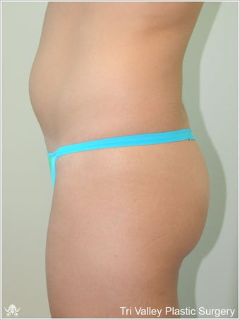  Brazilian Buttock Lift
