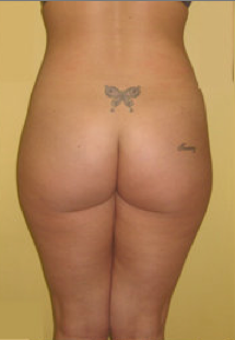 Buttock Augmentation