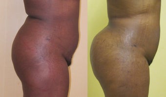Buttock Augmentation 