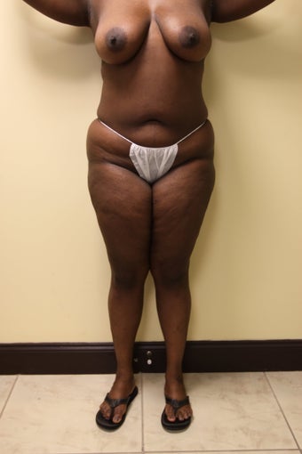 Brazilian Butt Lift
