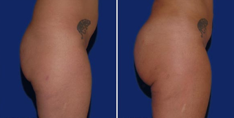 Brazilian Butt Lift