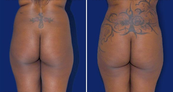 Brazilian Butt Lift