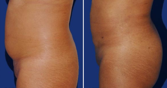 Brazilian Butt Lift