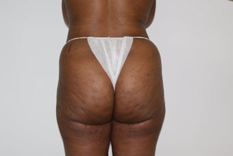 Brazilian Butt Lift