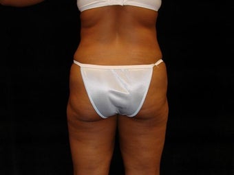 Buttocks Augmentation