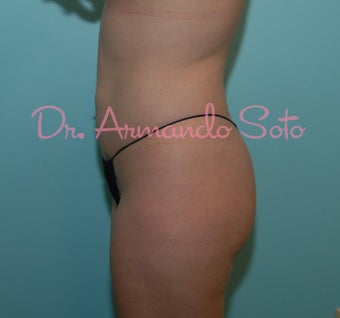 Brazilian Butt Lift