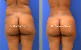 Brazilian Buttock Lift