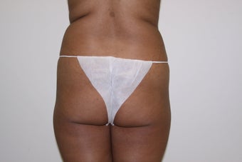 Brazilian Butt Lift
