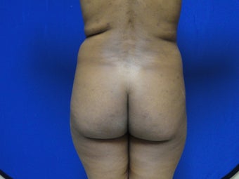 Brazilian Butt Lift/Fat Grafting Buttock Augmentation
