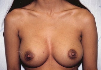 Breast Augmentation