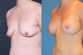 Breast Augmentation and Lift