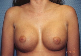 Breast Augmentation