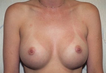 Breast Augmentation