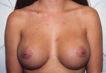 Breast Augmentation
