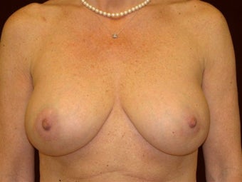 Breast augmentation