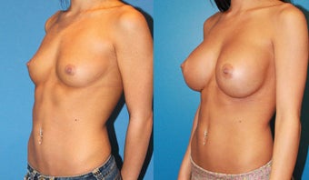 Breast Augmentation