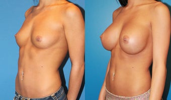 Breast Augmentation