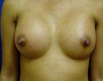 Breast Augmentation 