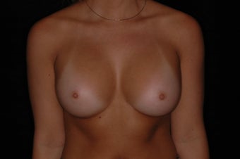 Breast Augmentation