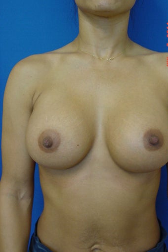 Breast Augmentation