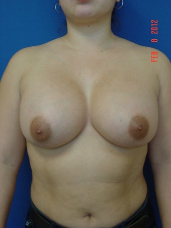 Breast Augmentation
