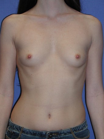 Breast Augmentation Surgery