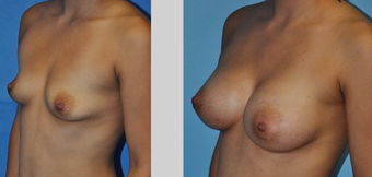 Flash Recovery Breast Augmentation TM