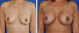 Flash Recovery Breast Augmentation TM