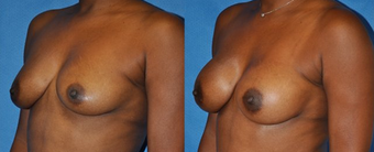 Flash Recovery Breast Augmentation TM
