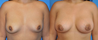 Flash Recovery Breast Augmentation TM